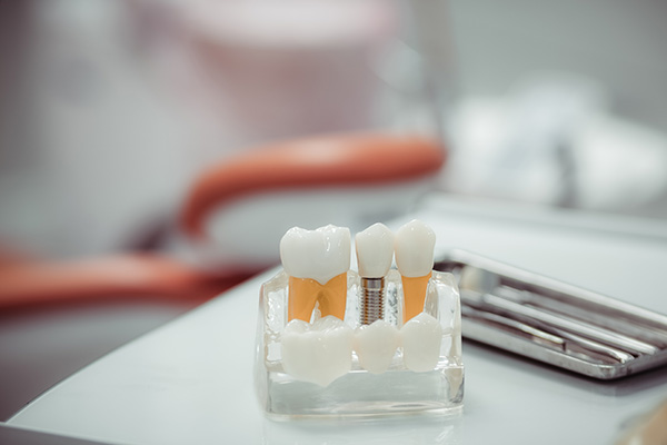 What A Dentist Recommends For Dental Implants Aftercare