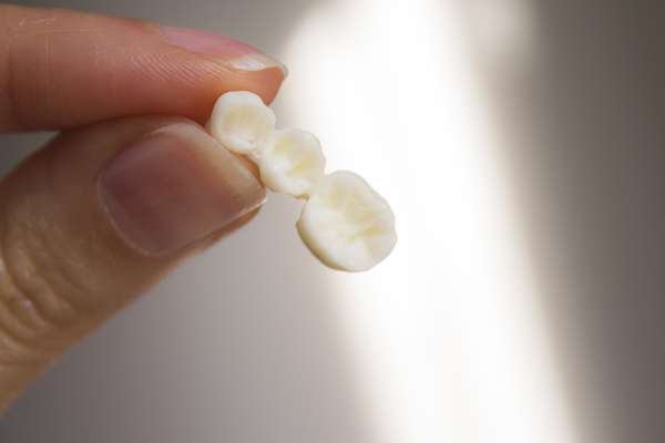 Bridges vs. Dental Implants: Which Is Better from Siegert Dental in Onalaska, WI