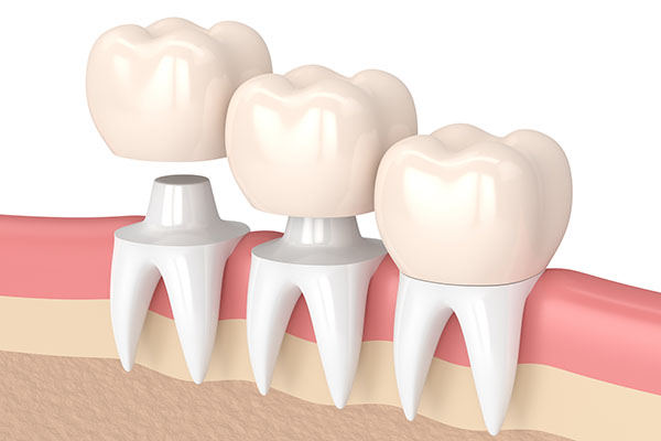 Choose CEREC Ceramic Crowns Over Other Traditional Crown Materials from Siegert Dental in Onalaska, WI