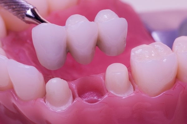 Pros And Cons Of Dental Bridges