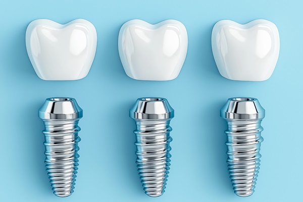 Simple Steps To Place Dental Implants