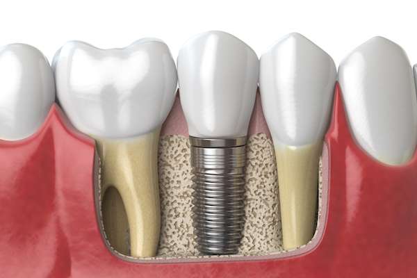 Dental Implants for Replacing Missing Teeth from Siegert Dental in Onalaska, WI