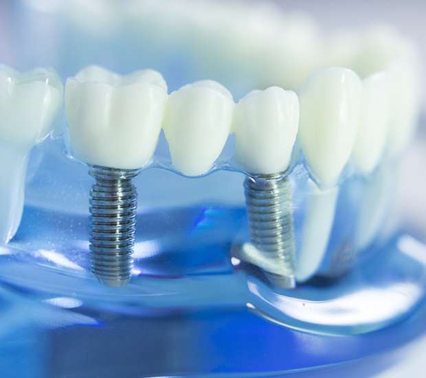 Onalaska Dental Implants