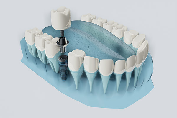 FAQs about Dental Implants from Siegert Dental in Onalaska, WI