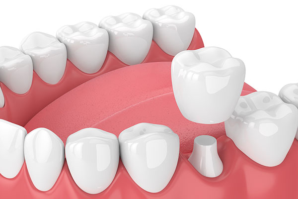 How a CEREC Restoration Can Help a Damaged Tooth from Siegert Dental in Onalaska, WI