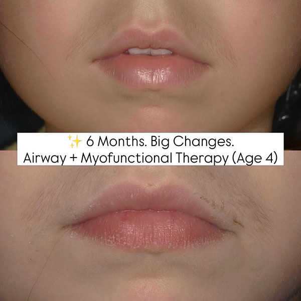 airway and myofunctional changes age 4