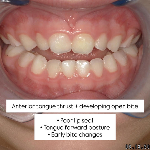anterior tongue thrust and developing open bite