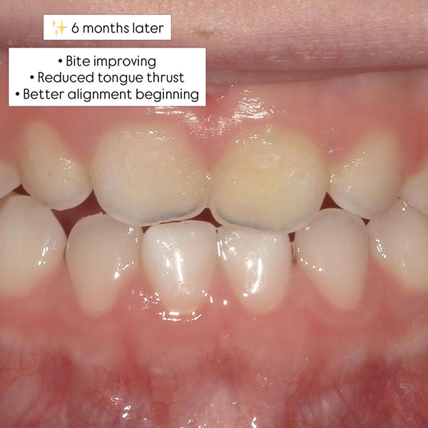 improvement case airway