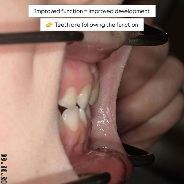 improvement case airway