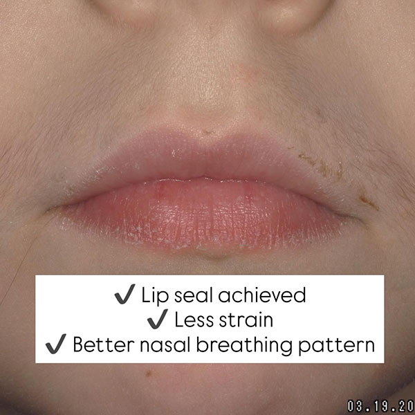 improvement case airway