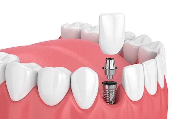 Mini vs. Regular Dental Implants from Siegert Dental in Onalaska, WI