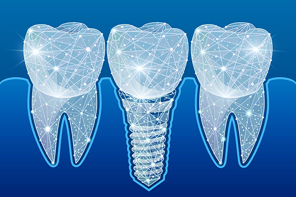 Preventing Complications After Getting Dental Implants from Siegert Dental in Onalaska, WI
