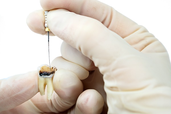 Root Canal Questions: What Is Tooth Pulp?