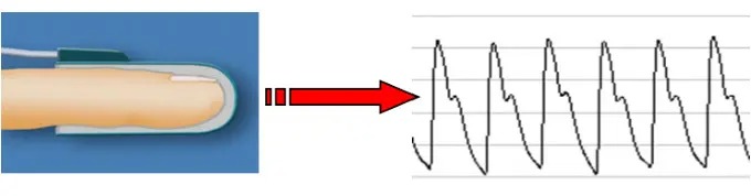 WATCH PAT 200 Sleep Apnea Detection