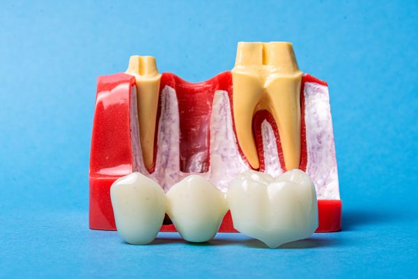 Learning Which Tooth Replacement Option To Choose: Implants, Bridges, Or Dentures?
