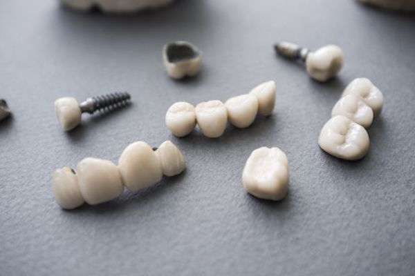 Types of Dental Implants from Siegert Dental in Onalaska, WI
