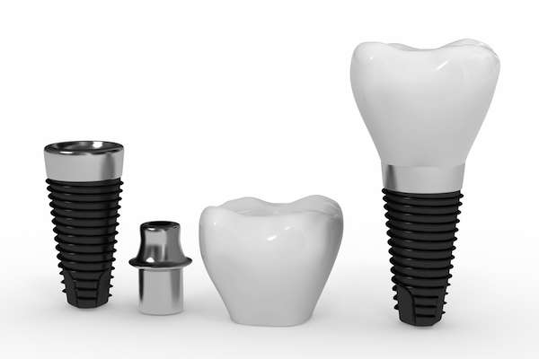 What Are the Parts of Dental Implants from Siegert Dental in Onalaska, WI