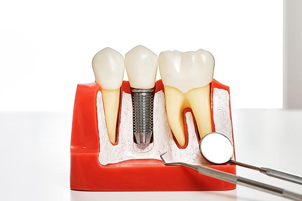 Your Guide to Different Kinds of Dental Implants from Siegert Dental in Onalaska, WI