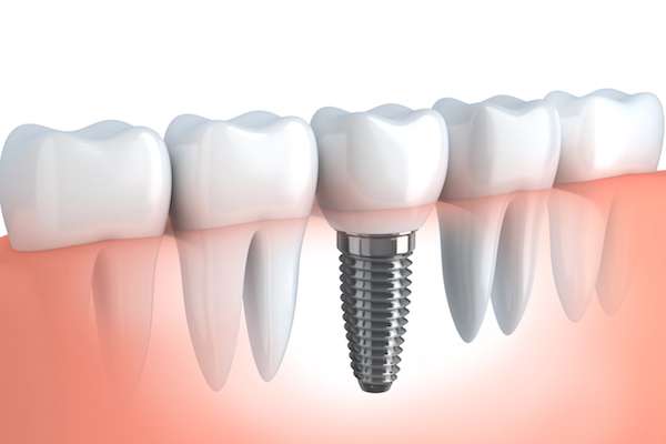 Your Ultimate Guide To Getting Dental Implants